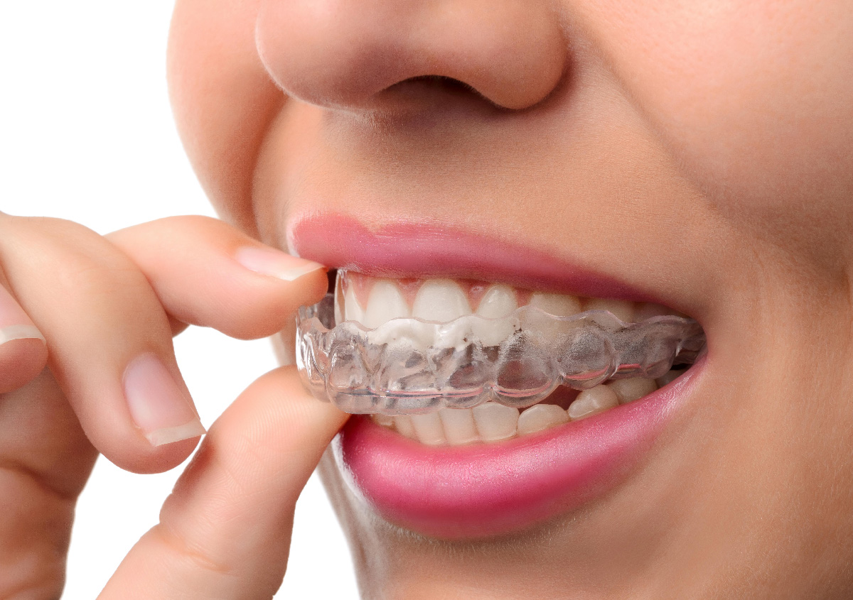 how comfortable Invisalign trays, Arden, NC
