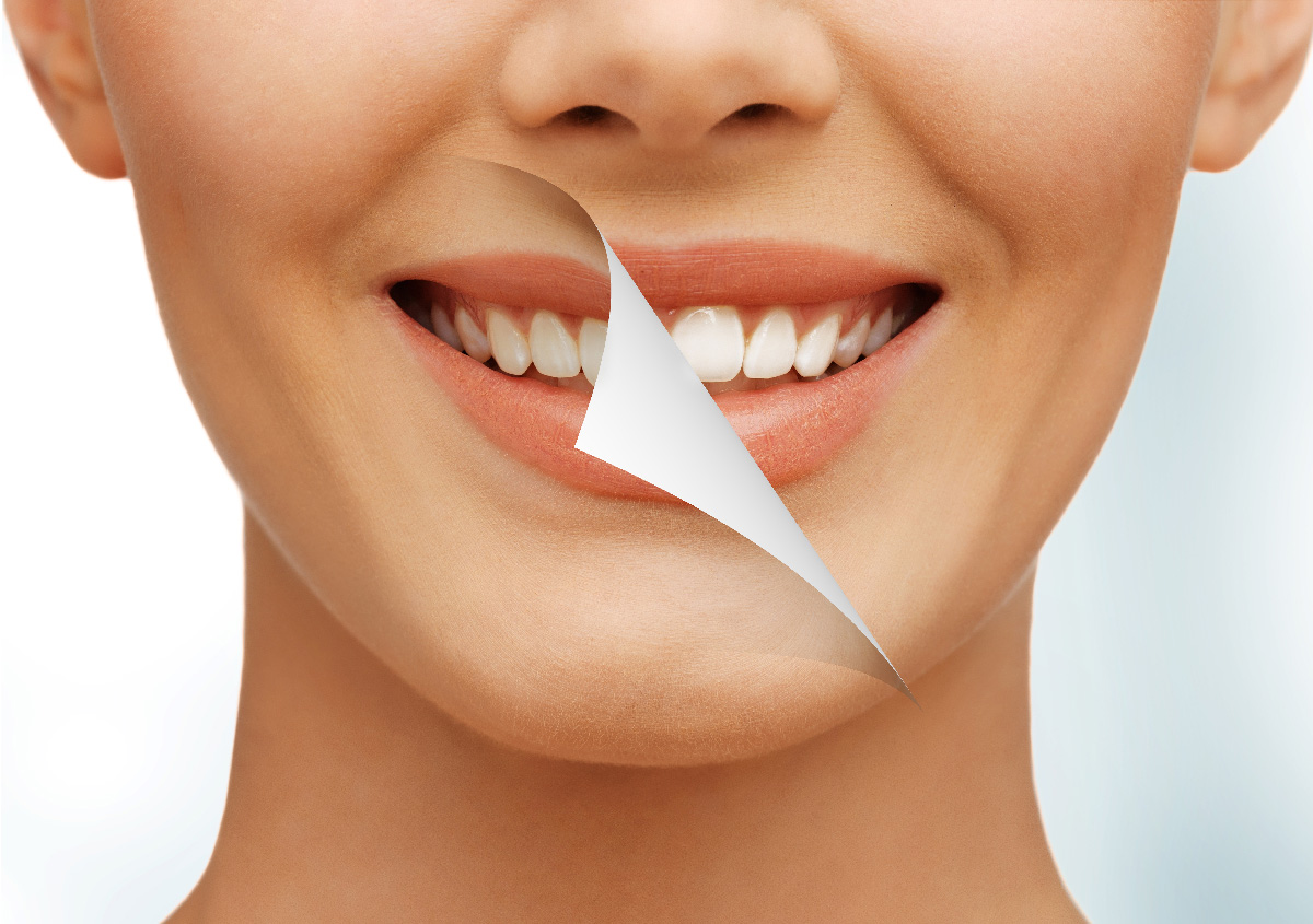 Teeth Whitening aftercare instructions Arden, NC