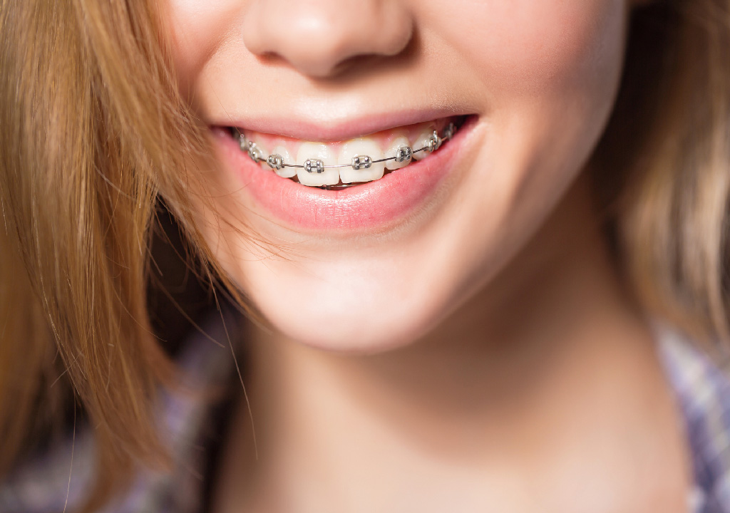 How Does 6 Months Smiles Differ From Traditional Braces, In Arden, NC