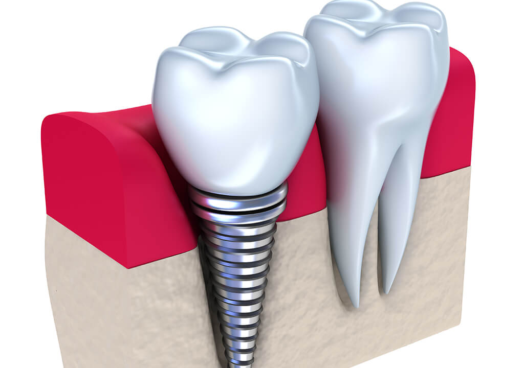 Affordable Dental Implants in Arden NC Area