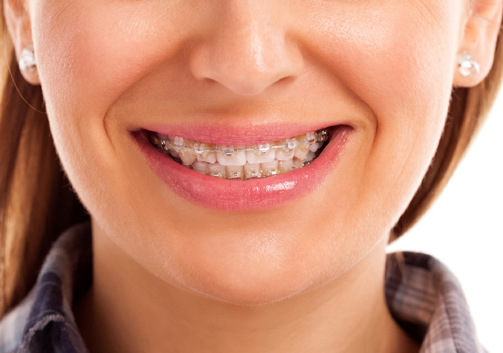 How cosmetic braces can transform a patient's smile, In Arden, NC