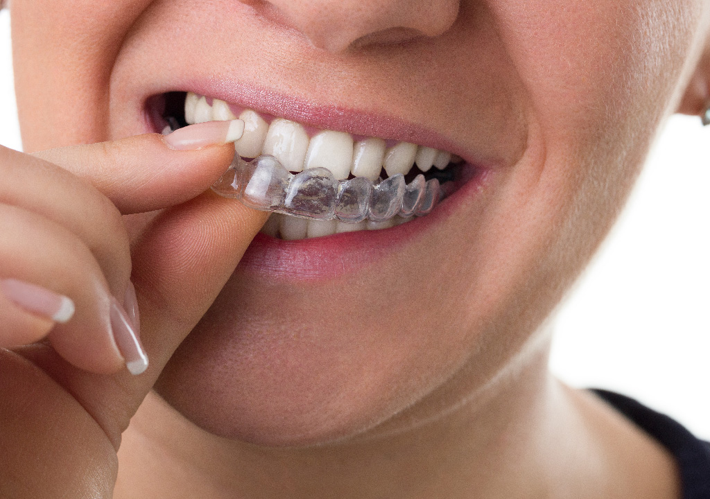 Does Invisalign really straighten teeth, In Arden, NC