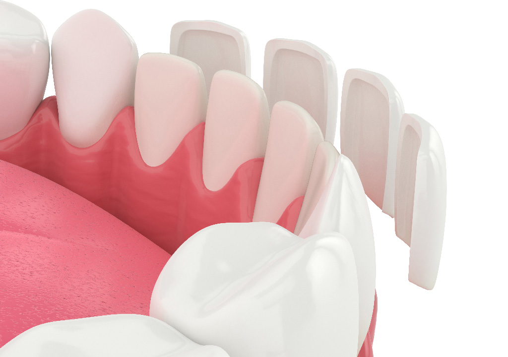 Learn More About Porcelain Veneers Treatment In, Arden, NC