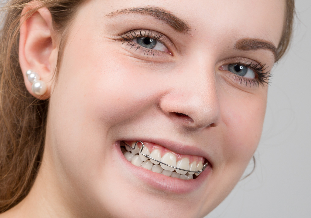Learn More About Six Month Smiles Dental Care Near Me, In Arden, NC