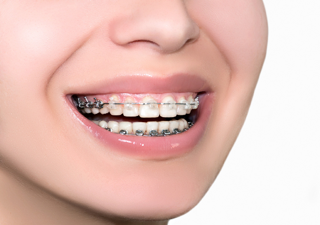 Guide To Wearing Six Month Smile Braces, In Arden, NC