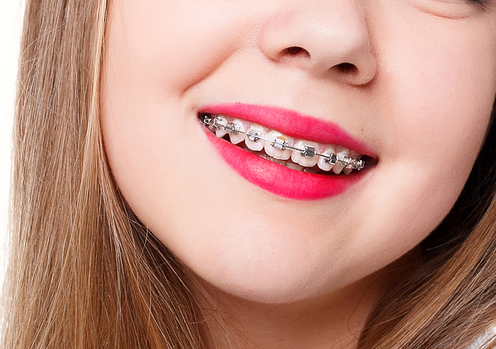 What Are The Available Orthodontic Options Near Me, In Arden, NC