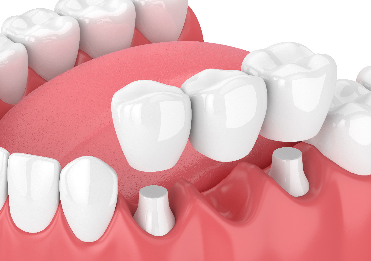 A dentist who provides Dental Bridge Replacement treatments near Me in Arden, NC