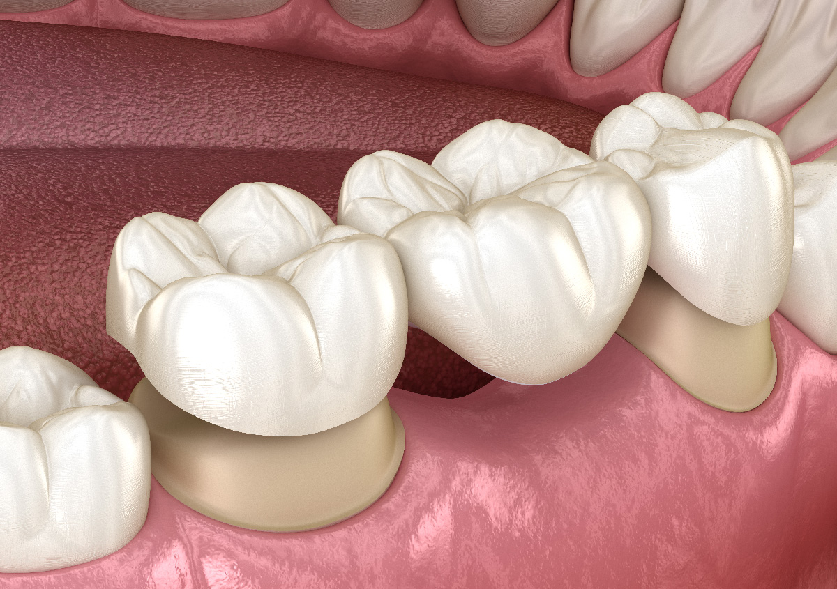 What Is The Difference Between Dental Bridges And Partials Near Me In Arden, NC