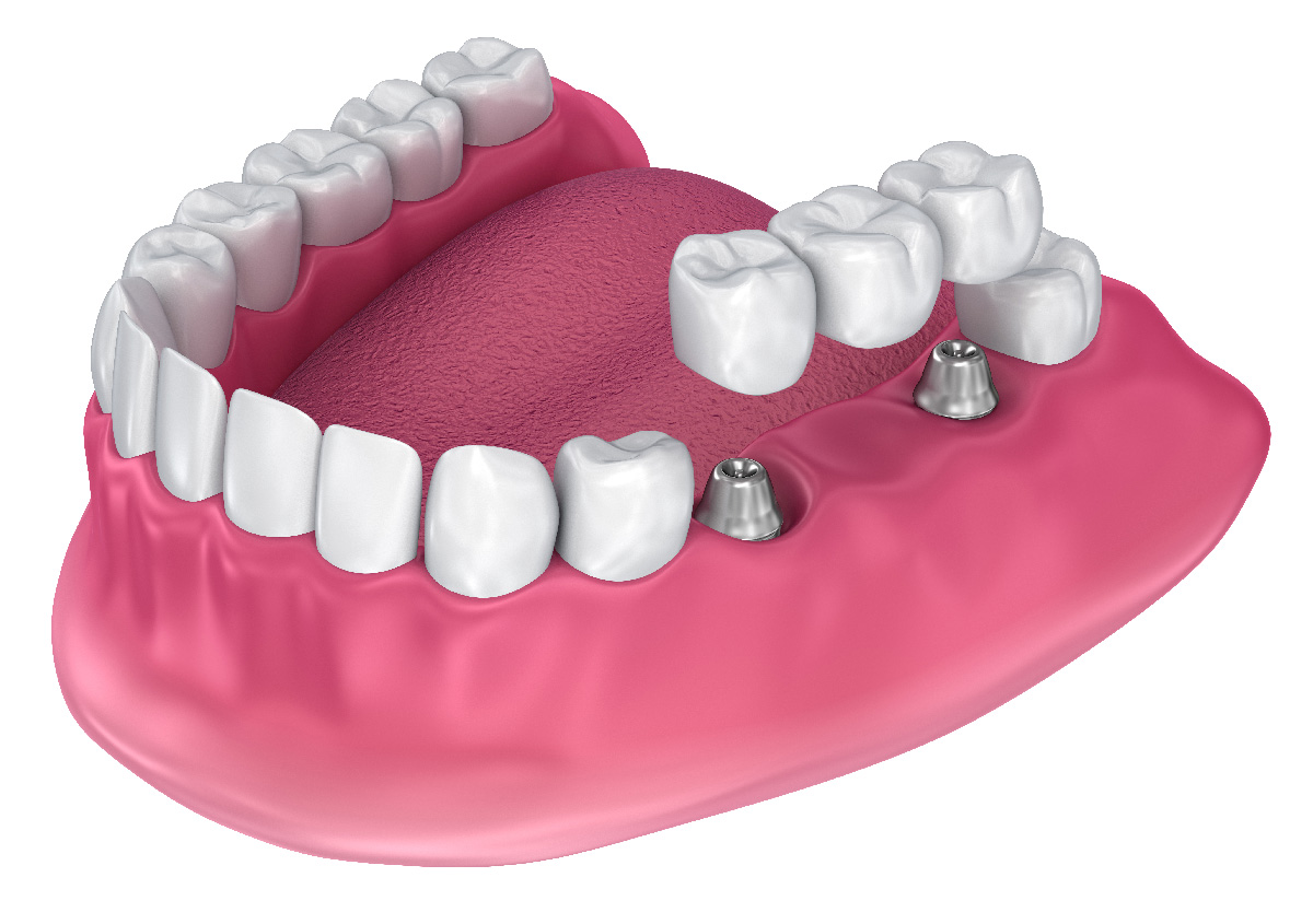 Learn More About Dental Crowns near me In Arden NC