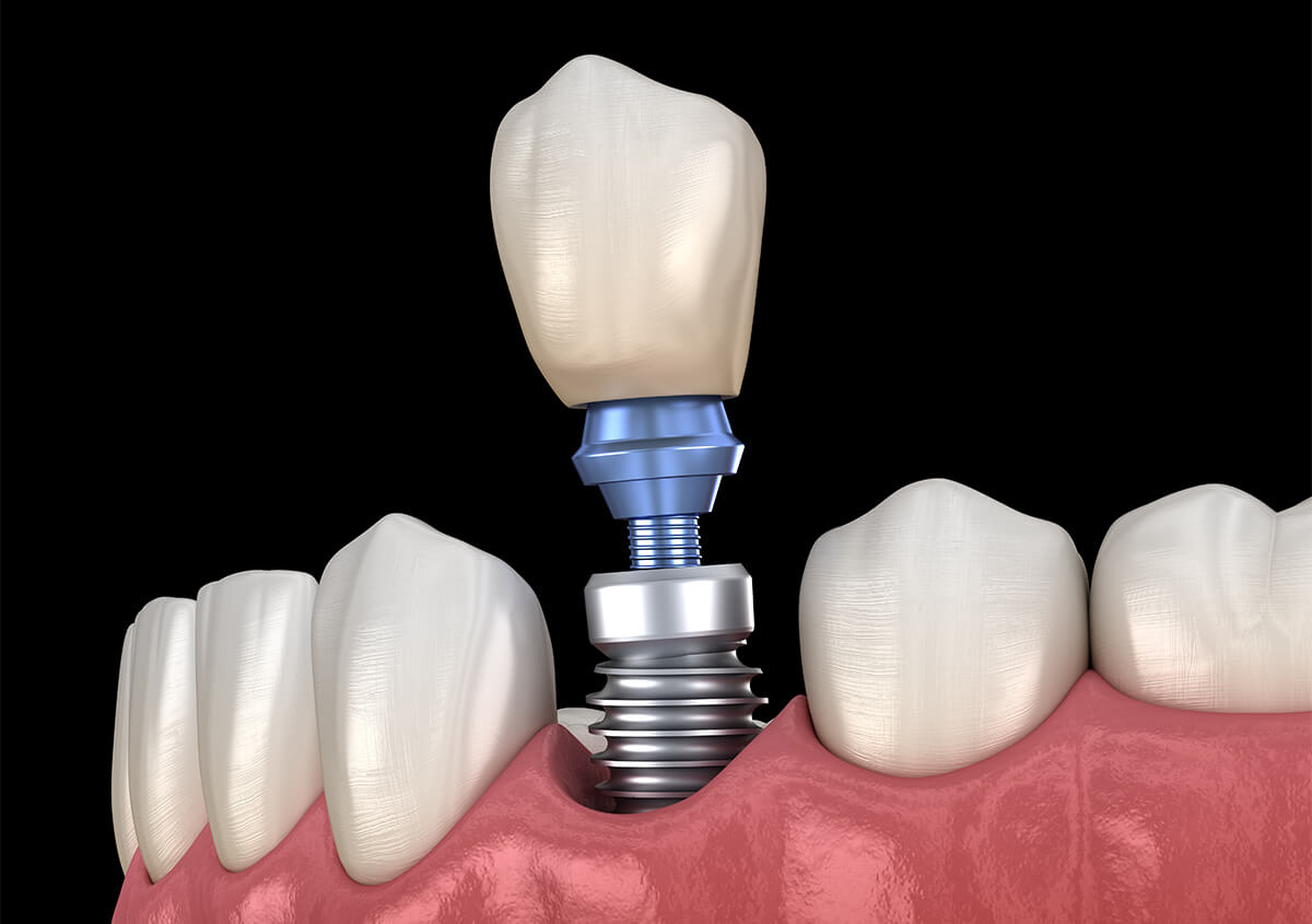 Full Arch Dental Implants in Arden NC Area